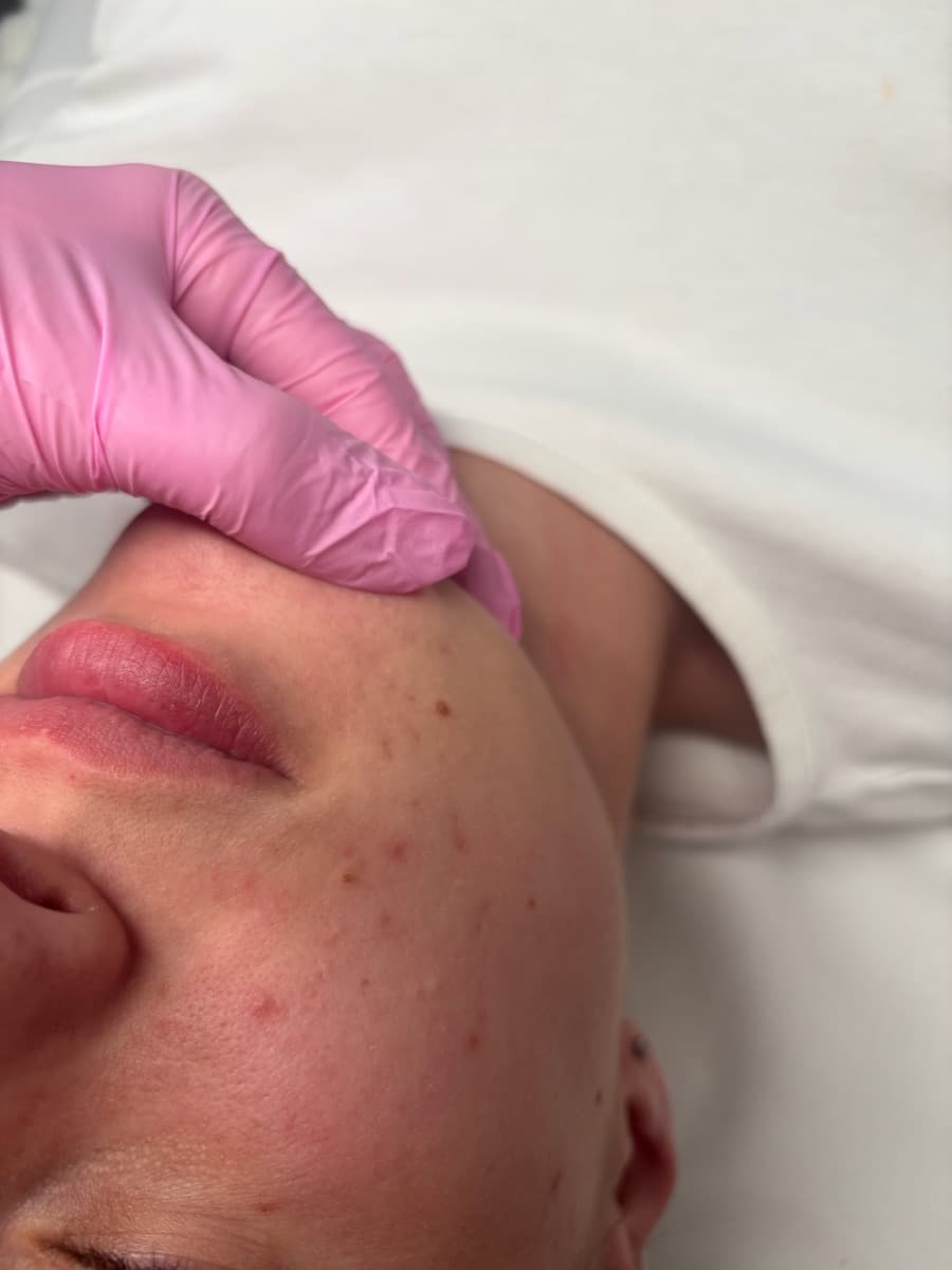 Dermaplaning treatment at Asena Beauty, Cuffley